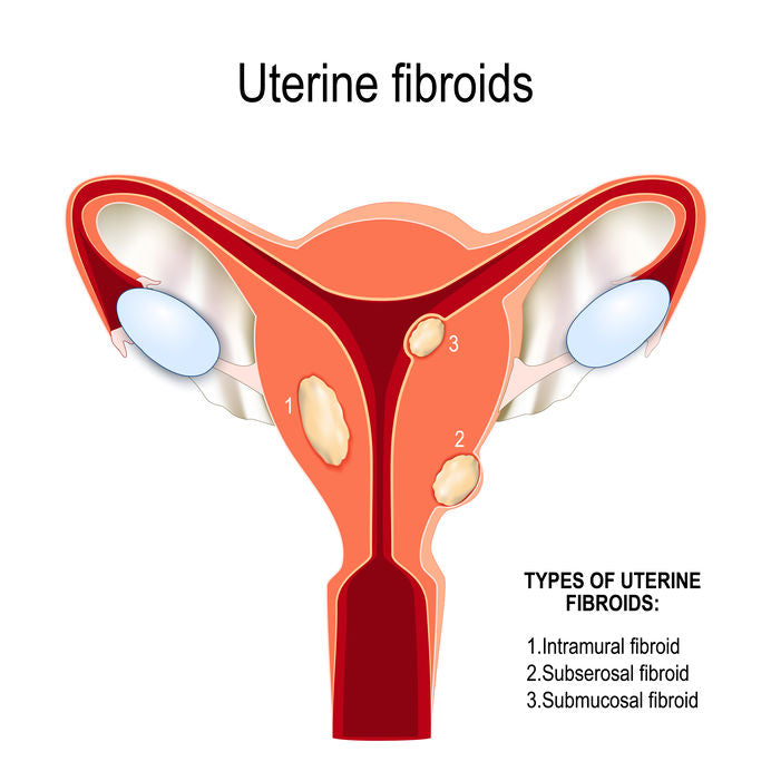 Can Fibroids Ruin Our Chances of Getting Pregnant?